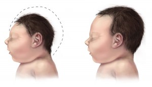 Duas ilustrações representando bebês recém-nascidos, comparando o tamanho de suas cabeças. Na imagem da esquerda, há um bebê com a cabeça menor, indicando microcefalia; à direita, há um bebê com a cabeça de tamanho regular